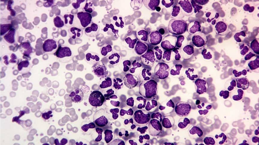 Abnormal WBC Morphology: Description, Types and Causes