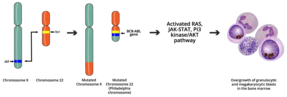 Unveiling the Molecular Mechanism of Chronic Myeloid Leukemia (CML): A Microscopic View of the Philadelphia Chromosome. Image depicting a microscopic view of a chromosome translocation resulting in the formation of the Philadelphia chromosome, a hallmark of CML.