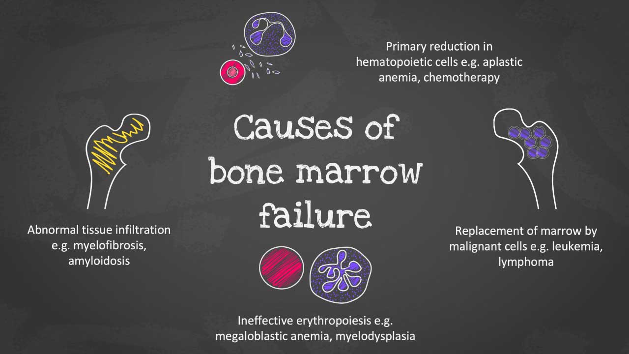An image highlighting the causes of bone marrow failure, including abnormal infiltration of non-hematopoietic cells and ineffective erythropoiesis, primary reduction of all blood cells and replacement of marrow by malignant cells leading to a disruption in blood cell production.