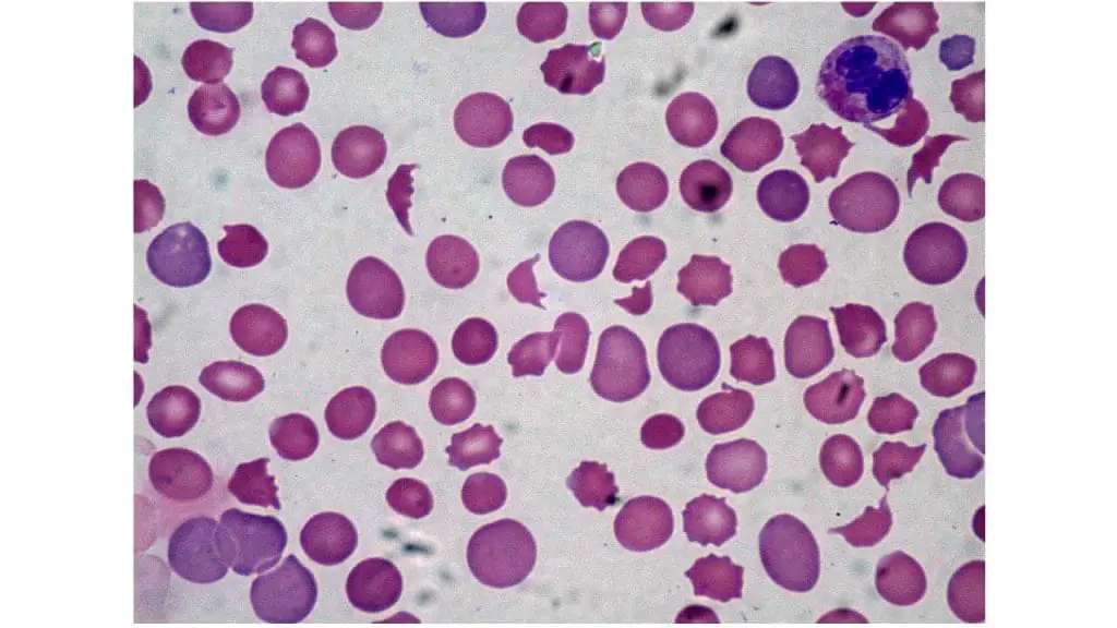 Presence of schistocytes in the peripheral blood smear