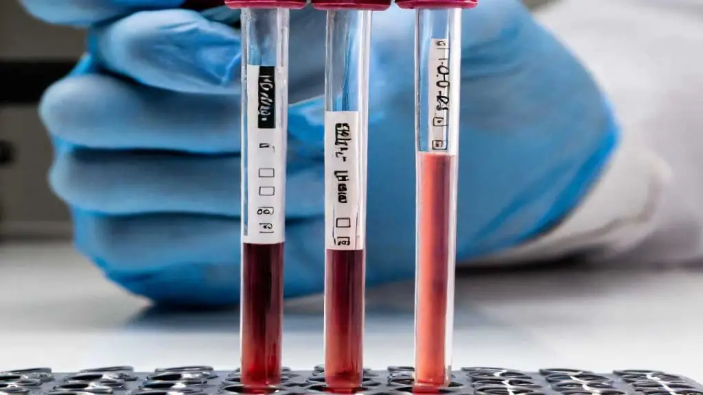 Image depicting a microscopic view of red blood cells settling in an ESR test tube, highlighting the impact of inflammation on red blood cell sedimentation