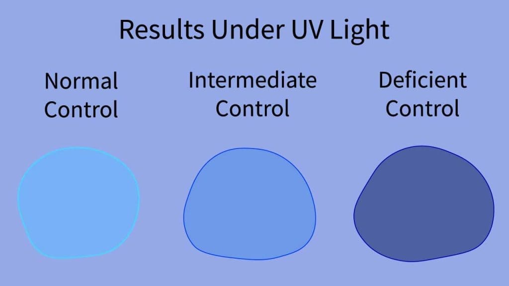 Flourescent spot test for G6PD deficiency: Normal G6PD activity: Bright green fluorescence. Intermediate G6PD activity: Reduced or yellowish fluorescence. No or very weak fluorescence.