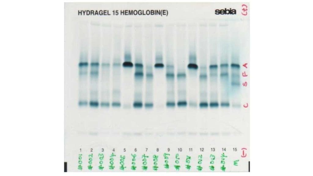 Gel electrophoresis results, illustrating the identification of abnormal hemoglobin variants including Hb H and Hb Barts as fast moving bands in alpha thalassemia. 