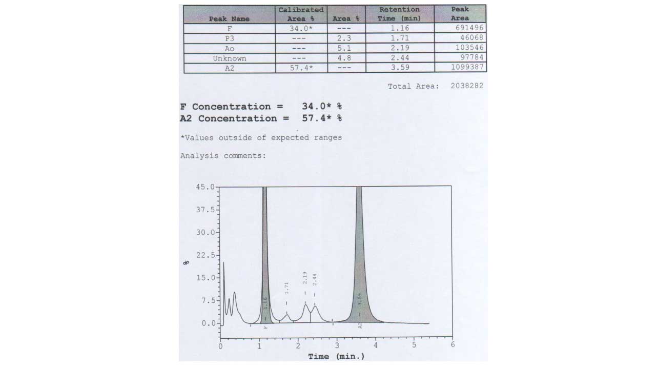 HPLC chromatogram indicating elevated HbA2 levels, potentially suggesting homozygous Hb E.