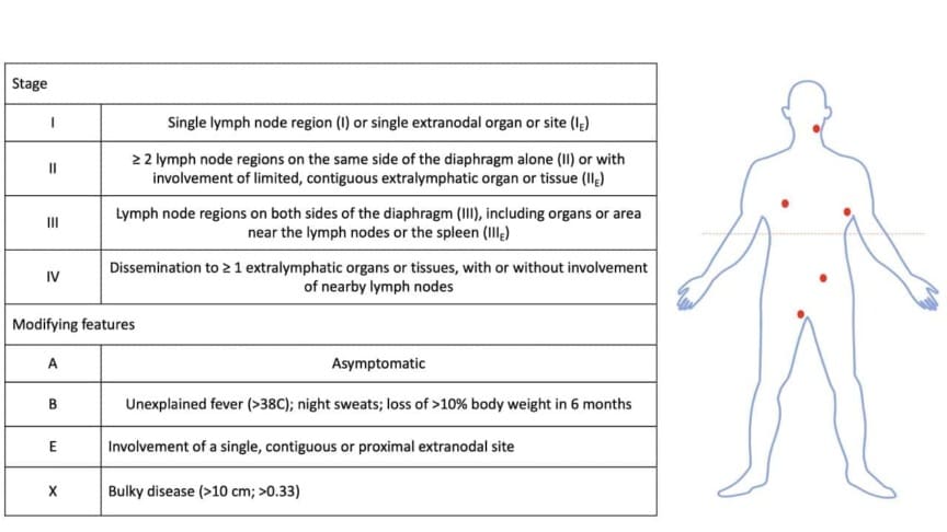 H Staging Classic Hodgkin Lymphoma Treatment Strategies | My Hematology