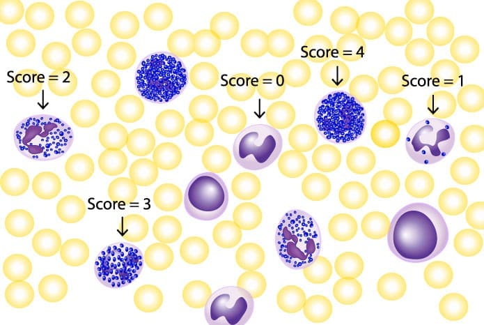NAP Scoring System for Peripheral Blood Smear Evaluation - Illustrates the NAP scoring system used to quantify neutrophils - whether they are mainly mature or immature cells.