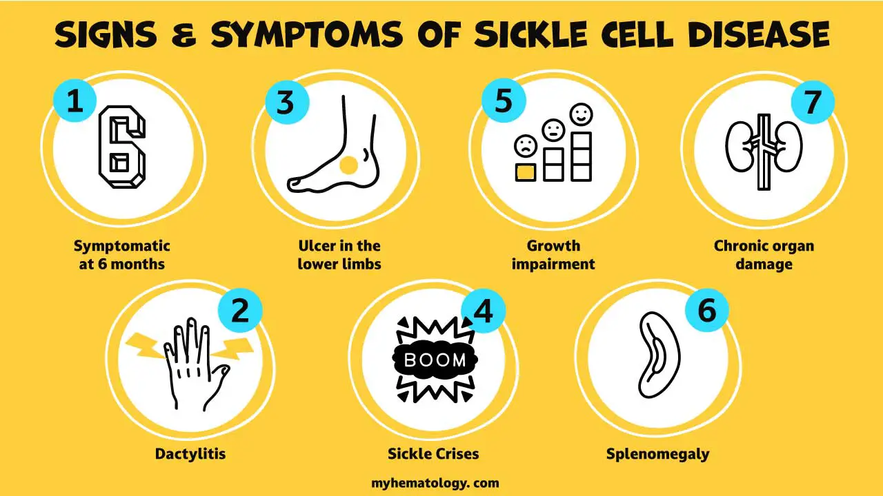 An infographic detailing the signs and symptoms of of sickle cell anemia including skin ulcer in the lower limbs.