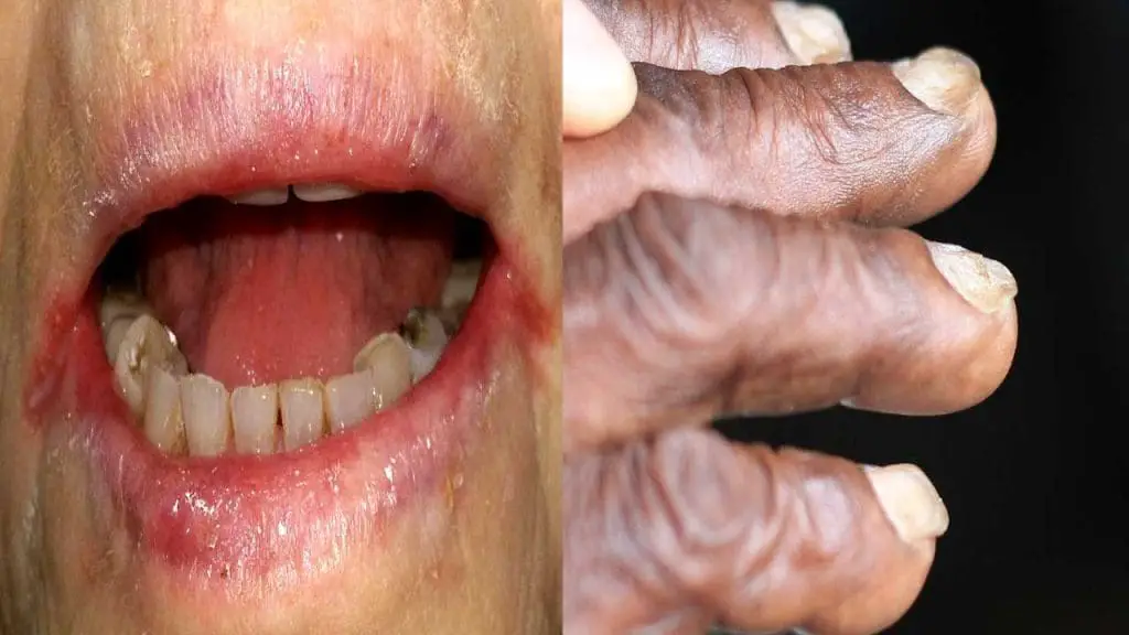 Specific signs of IDA: Angular cheilitis on the left and koilonychia on the left. 