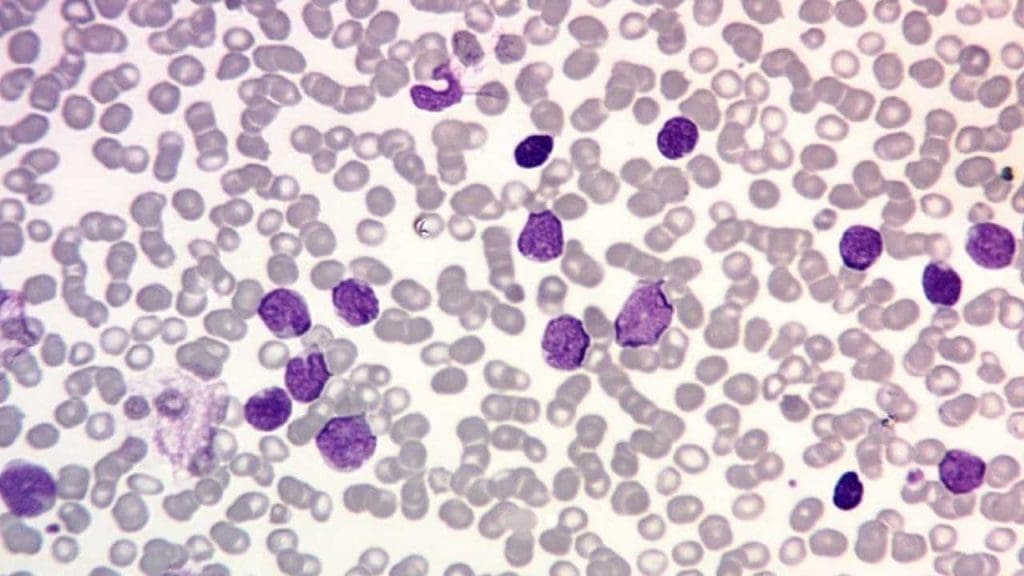 High-magnification peripheral blood smear revealing numerous lymphoblasts, indicative of acute lymphoblastic leukemia (ALL).