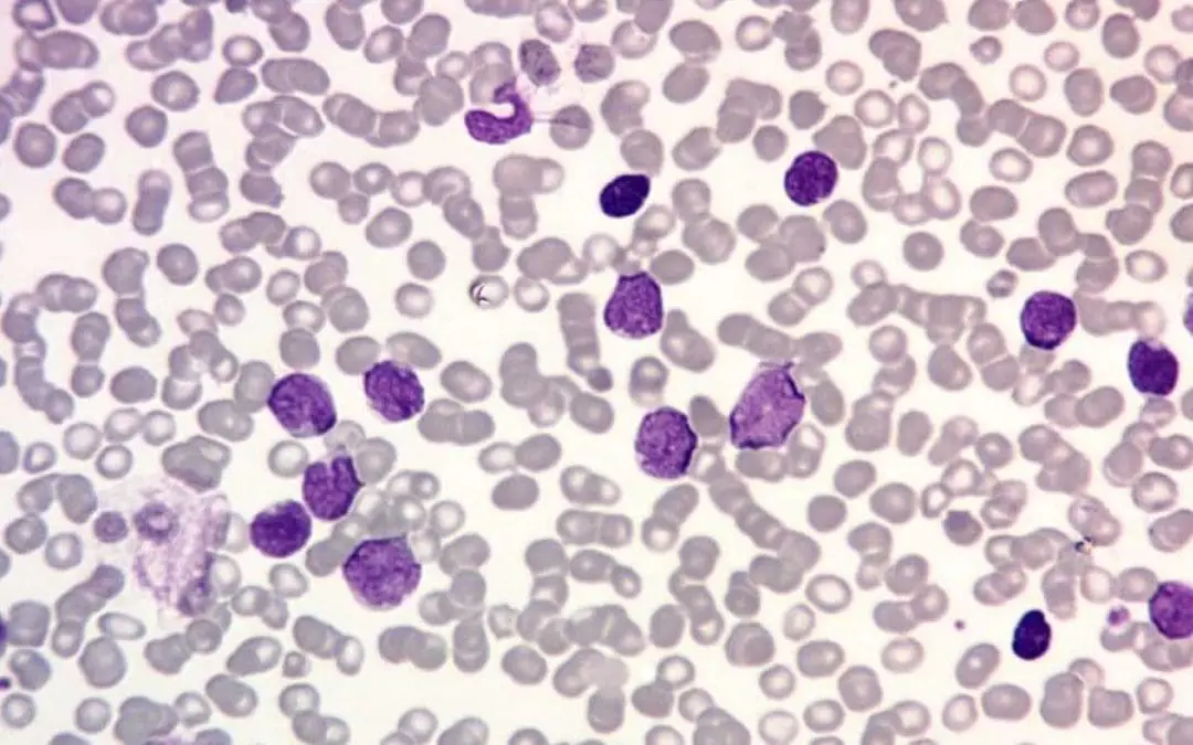 T-cell Acute Lymphoblastic Leukemia (T-cell ALL)