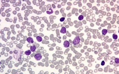 T-cell Acute Lymphoblastic Leukemia (T-ALL)