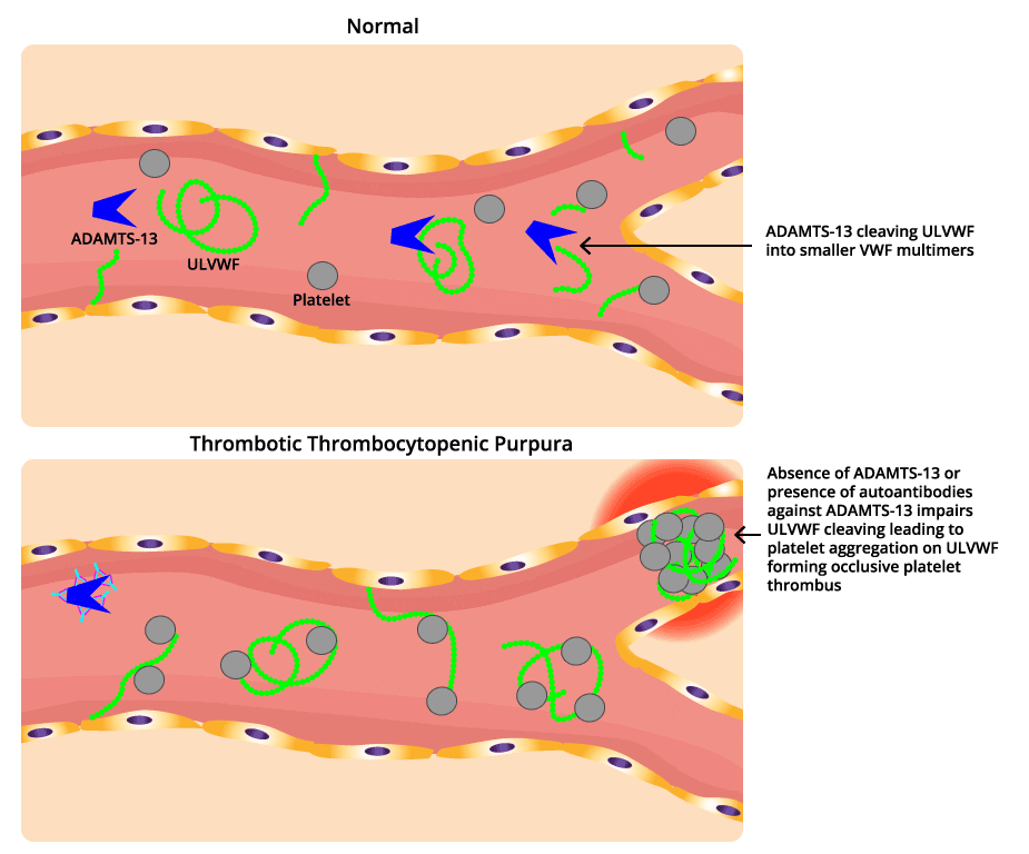 Thrombocytopenia in TTP: A Microscopic Look at ADAMTS-13 Deficiency and Platelet Aggregation - Illustrates the absence of ADAMTS-13, a crucial enzyme, leading to platelet aggregation and blood clot formation in thrombotic thrombocytopenic purpura (TTP).