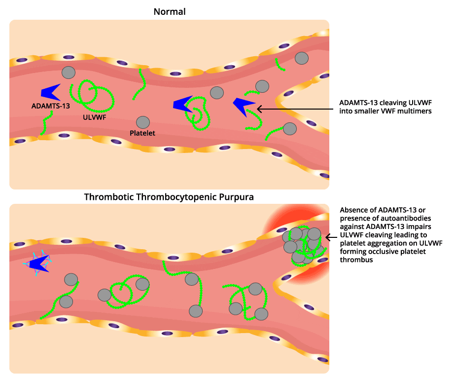 Thrombocytopenia: Causes, Symptoms, Investigations & Management