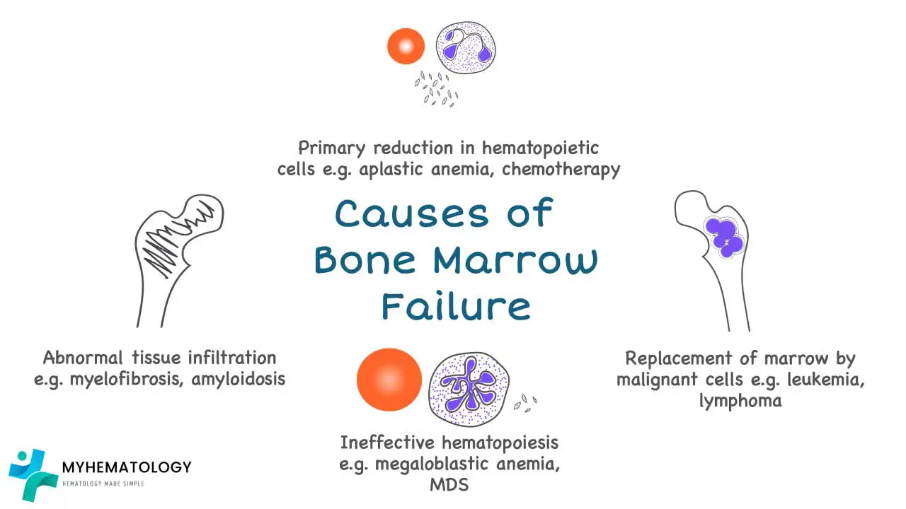 This snapshot provides a glimpse into the pathogenesis of bone marrow failure, a condition characterized by a severe reduction in blood cell production.