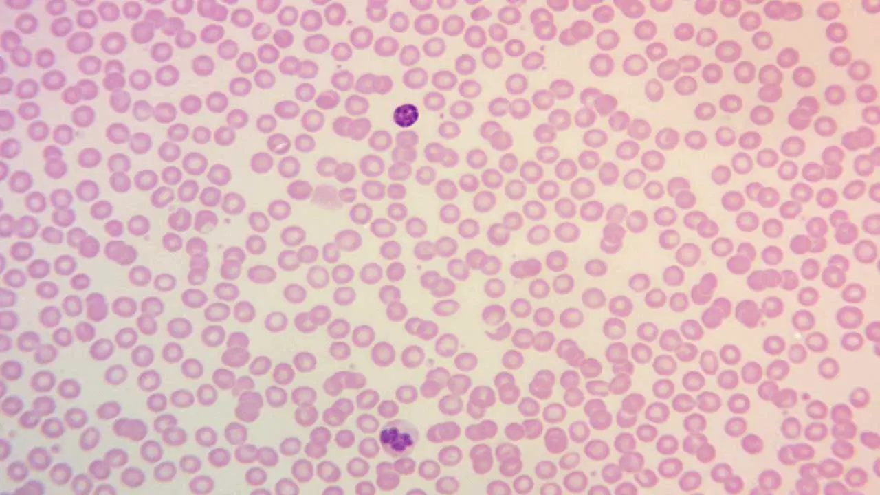 Image depicting a normal peripheral blood smear using Leishman stain, highlighting the consistent size and shape of red blood cells with central pallor occupying approximately one-third of their diameter