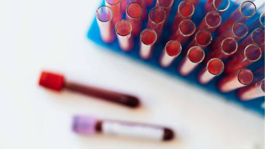 ABO Rh Test (Blood Group Typing) Tube Procedure & Interpretation