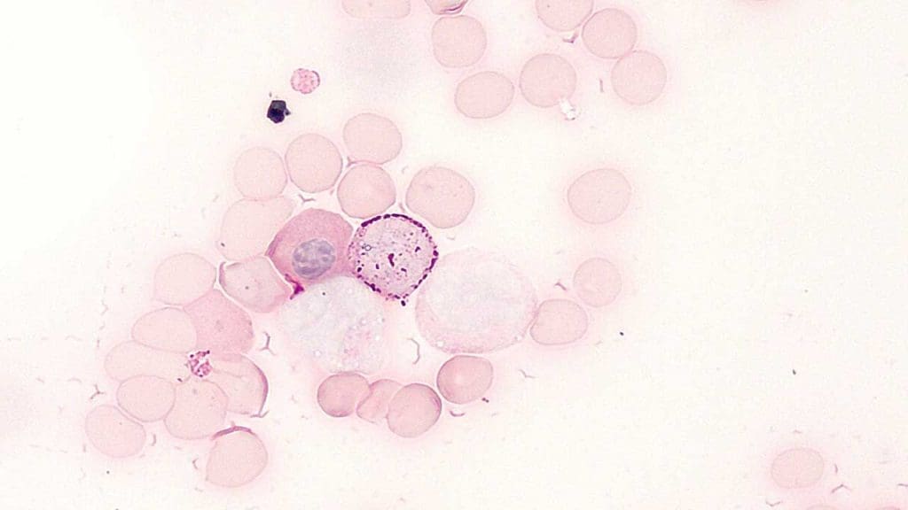 Bone marrow with B-ALL: PAS stain. Cell located upper-right to center contains crimson granules and fusion blocks, indicating B-ALL. "ALL PAS stain" by Animalculist is licensed under CC BY-SA 4.0.