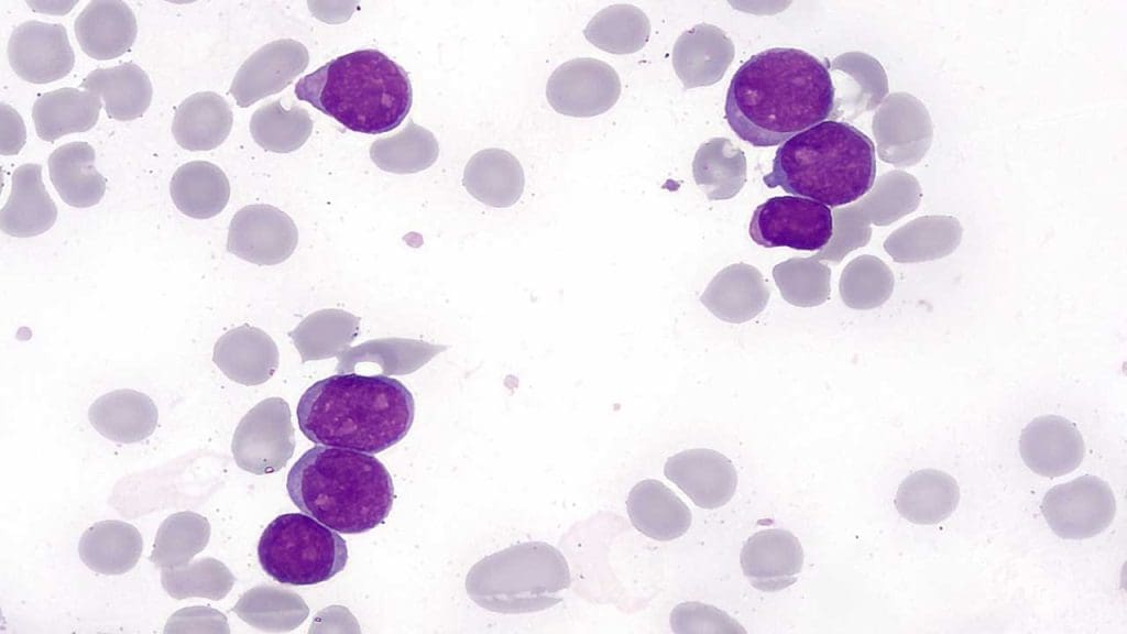 Minimally differentiated acute myeloid leukemia cells have no distinctive morphological differences from normal myeloblasts (AML M0)