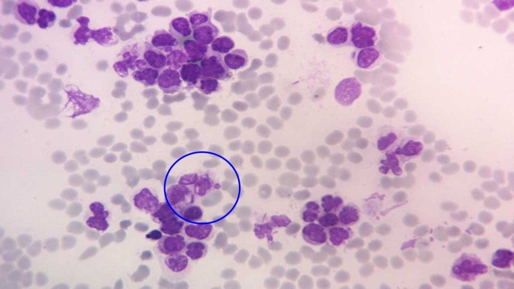 Microscopic view of acute myeloid leukemia (AML) showcasing characteristic needle-shaped Auer rods within myeloid cells - a disease in the scope of hemato-oncology