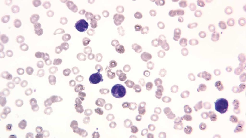 Microscopic image of acute promyelocytic leukemia (APL) exhibiting a couple of hypergranular promyelocytes and a couple of classic ‘buttock’ cells with a bilobed nucleus.