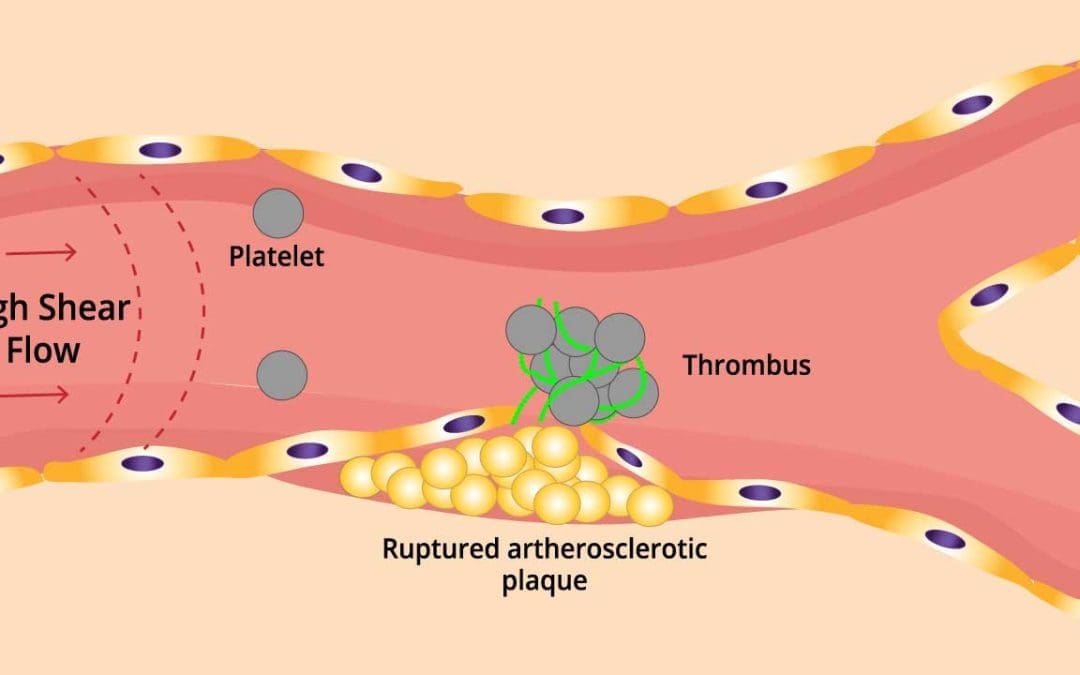 Arterial Thrombosis: A Silent Killer