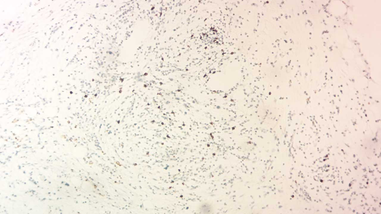 Microscopic view of a bone marrow biopsy showcasing a brown-stained CD20-positive B lymphocyte. This marker can reveal B-cell malignancies like lymphoma, aiding in accurate diagnosis. 