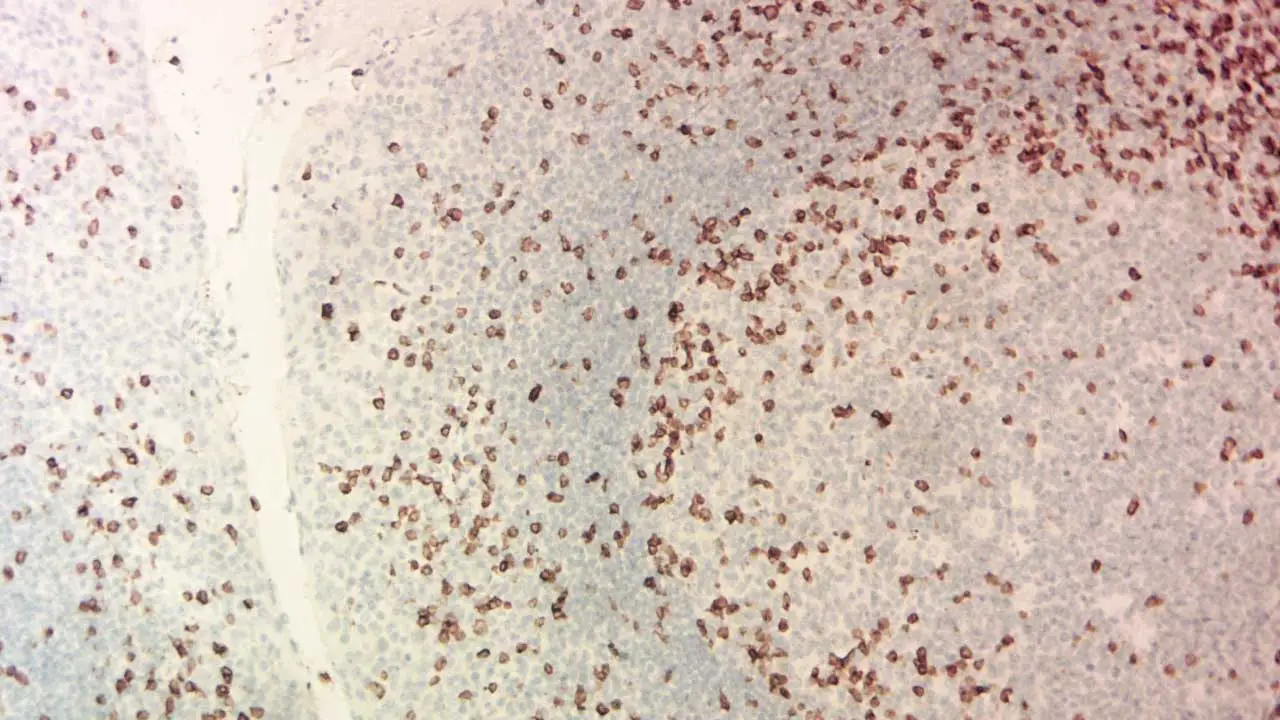 Microscopic image of a bone marrow trephine biopsy showcasing a CD3-positive T lymphocyte (brown stain) amidst other blood cells.