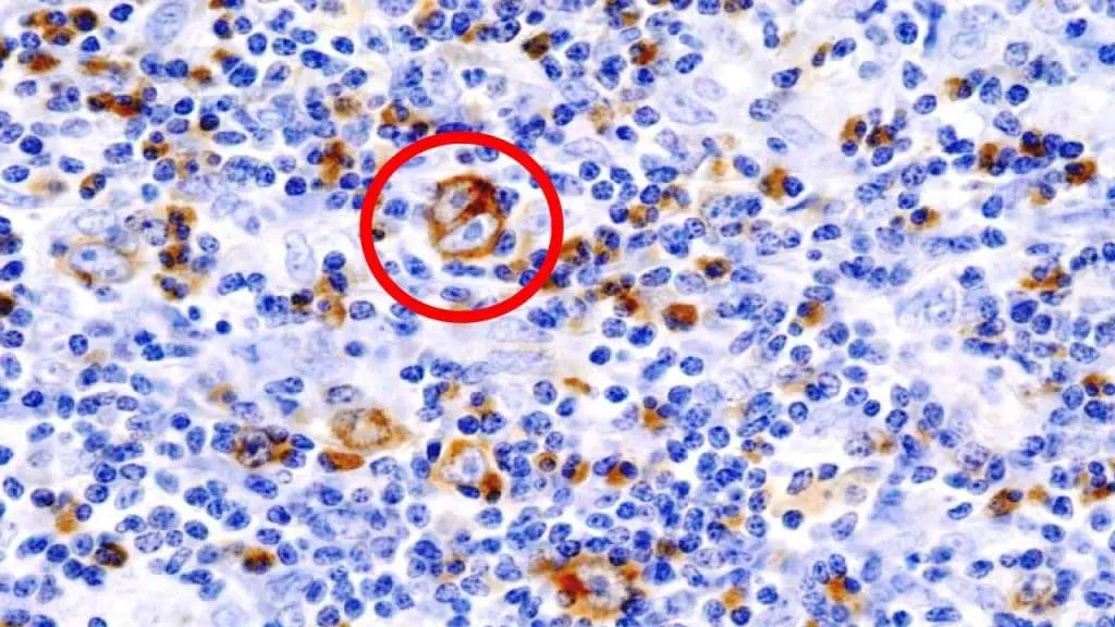 Microscopic image of a lymph node biopsy showing Reed-Sternberg cells, characteristic of Hodgkin's lymphoma. These large, binucleated cells have prominent cytoplasm and distinct nucleoli, appearing scattered amongst smaller lymphocytes. Their presence is crucial for diagnosing this type of blood cancer.