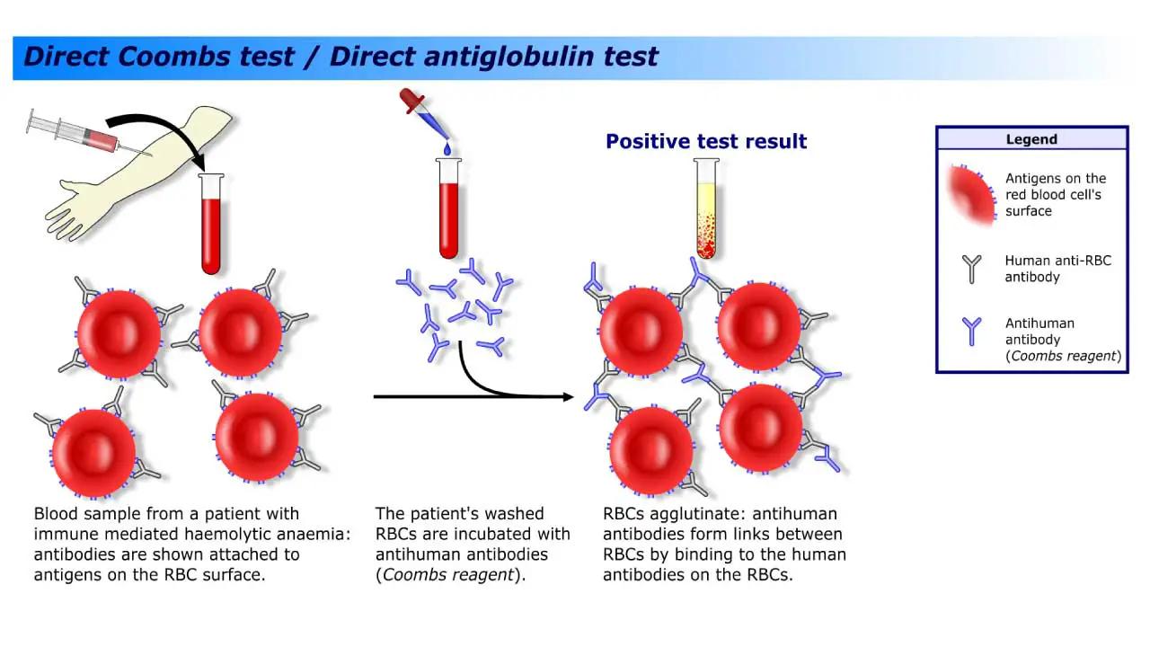 Agglutination of red blood cells in the direct antiglobulin test, revealing immune-mediated coating