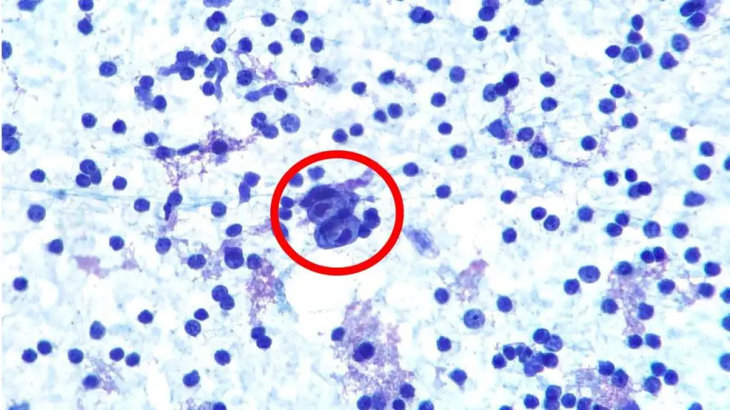 Fine needle aspirate of the lymph node showing the presence of Reed-Sternberg cell. 