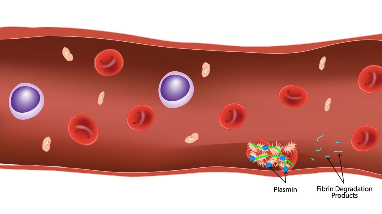 This image captures the dissolution of a blood clot by plasmin, a molecular enzyme. See the fibrin strands, once a protective mesh, breaking down into smaller fragments called fibrin degradation products (FDPs). This regulated process ensures the clot doesn't outstay its welcome, promoting smooth blood flow and tissue healing. 