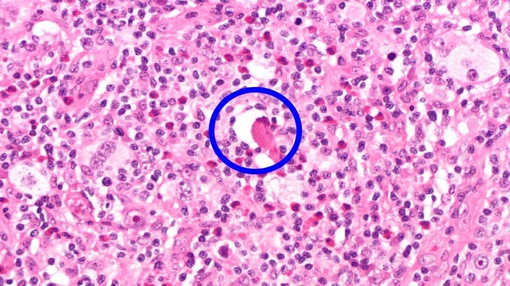 The cell in the centre is a lacunar cell - a dying Reed-Sternberg cell with a space around it.