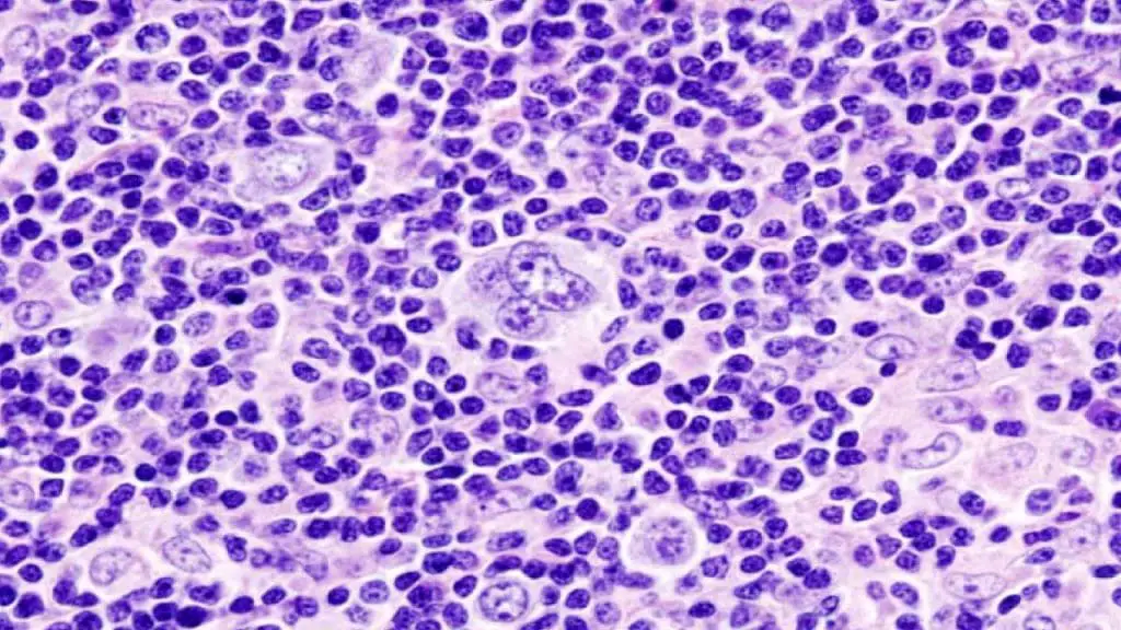 Histopathologic image of mixed cellularity Hodgkin lymphoma. Lymph node biopsy. H & E stain. 