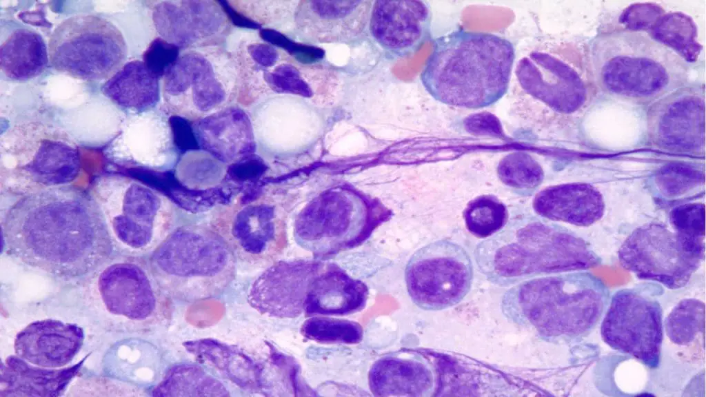 Atypical granulocytic lineage cells in a patient with myelodysplasia.