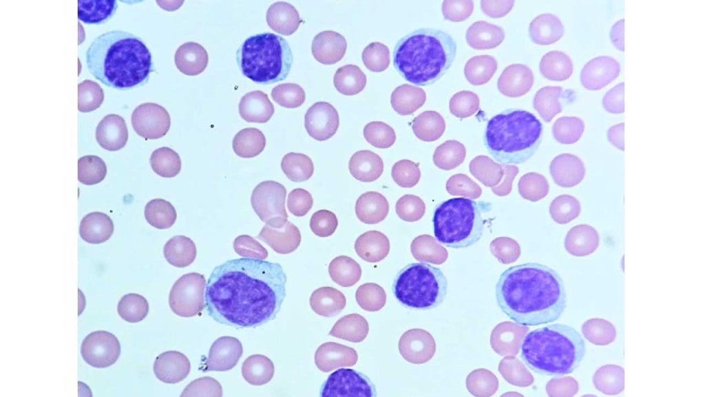 Image depicting a peripheral blood smear showcasing the hallmark findings of CLL