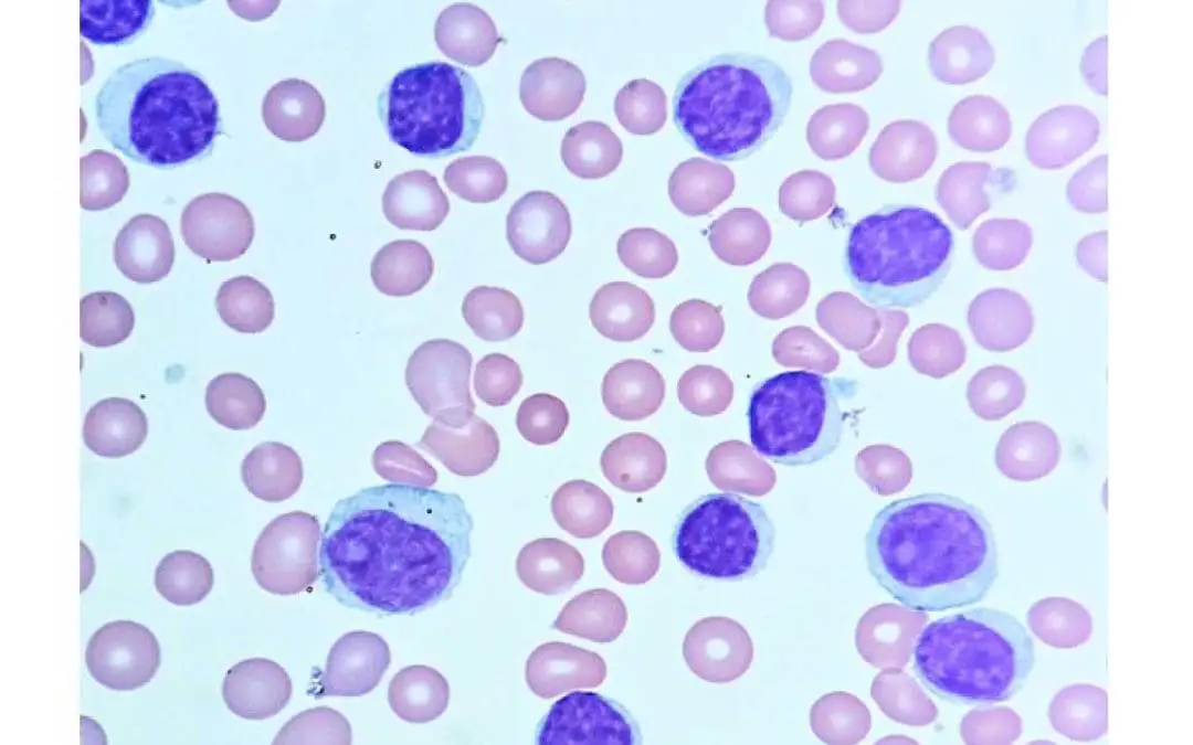 Chronic Lymphocytic Leukemia (CLL)