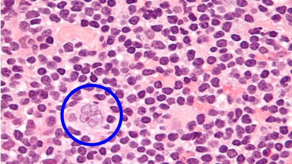 Very high magnification micrograph of nodular lymphoctye predominant Hodgkin lymphoma, abbreviated NLPHL, with a popcorn-shaped Reed-Sternberg cell. H&E stain.