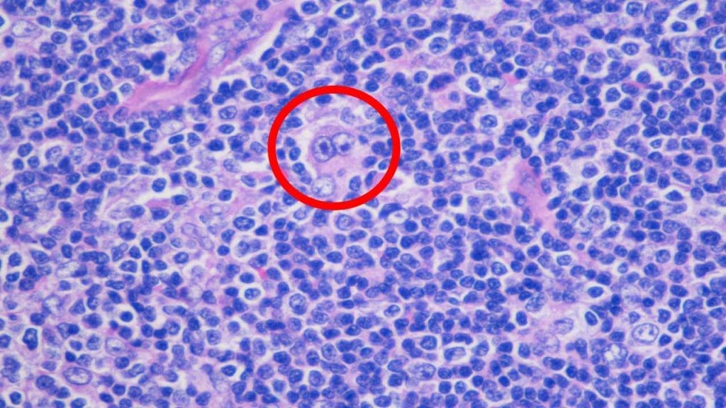 Reed-Sternberg cells in a lymph node biopsy indicating Hodgkin lymphoma, a hematology-related cancer. 