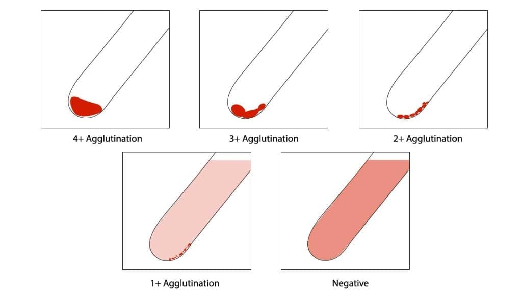 This image showcases the red cell agglutination test score. The distinct agglutination patterns observed in the test tubes provide definitive clues to presence of antibodies in the patient's serum.