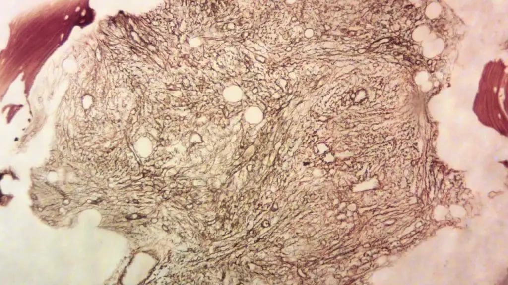 Extensive reticulin network with crossovers & thick collagen fibers, indicating advanced myelofibrosis (MF3). 