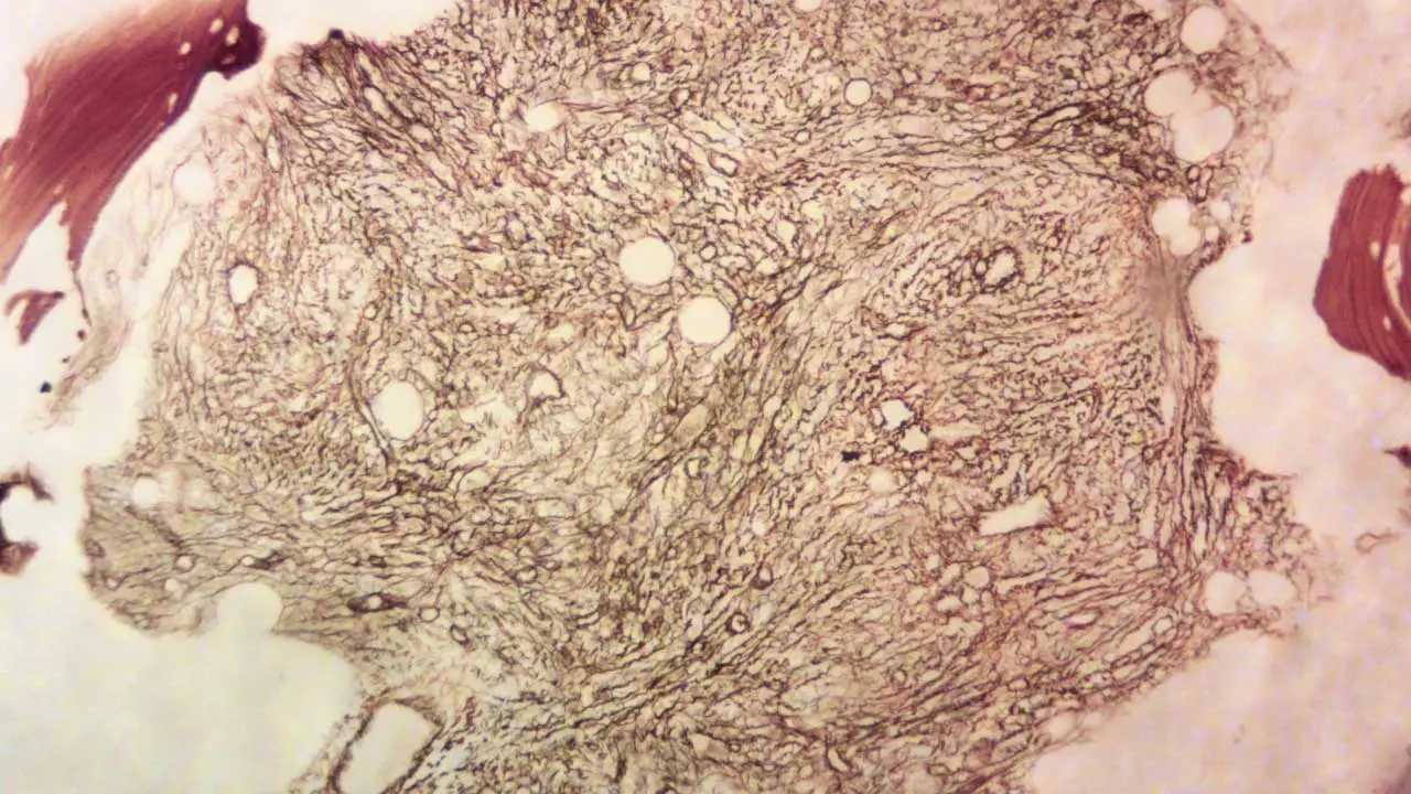 Extensive reticulin network with crossovers & thick collagen fibers, indicating advanced myelofibrosis (MF3).