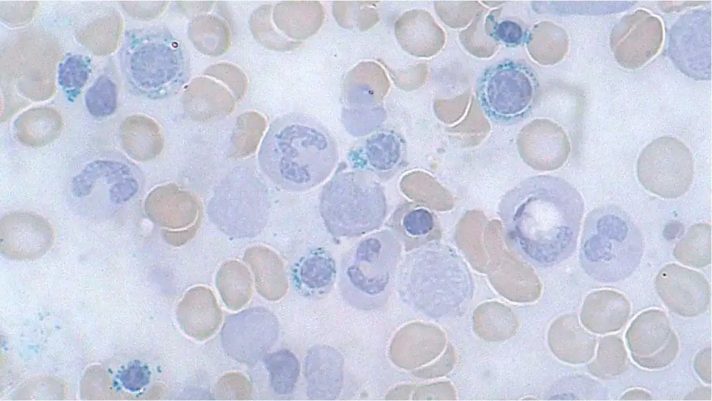 Bone marrow examination revealing the presence of ring sideroblasts, which are erythroid precursors (immature red blood cells) with perinuclear mitochondrial iron deposition in a characteristic ring formation stain bluish.