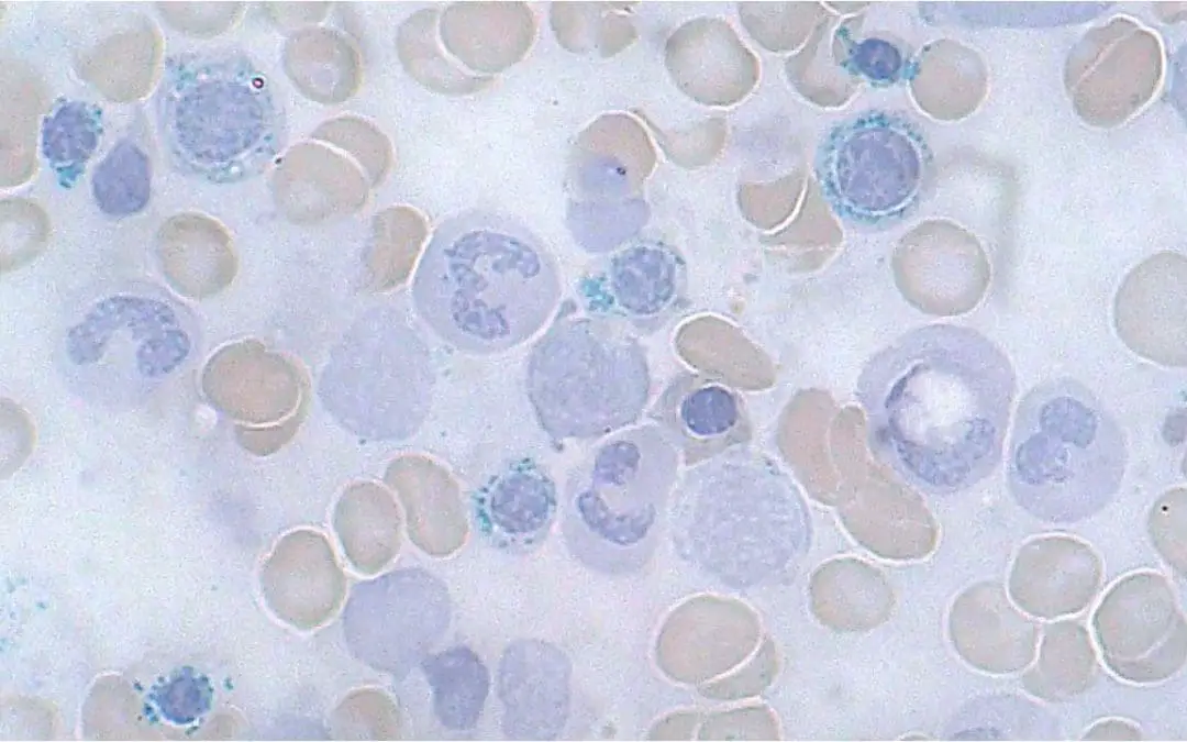 Sideroblastic Anemia