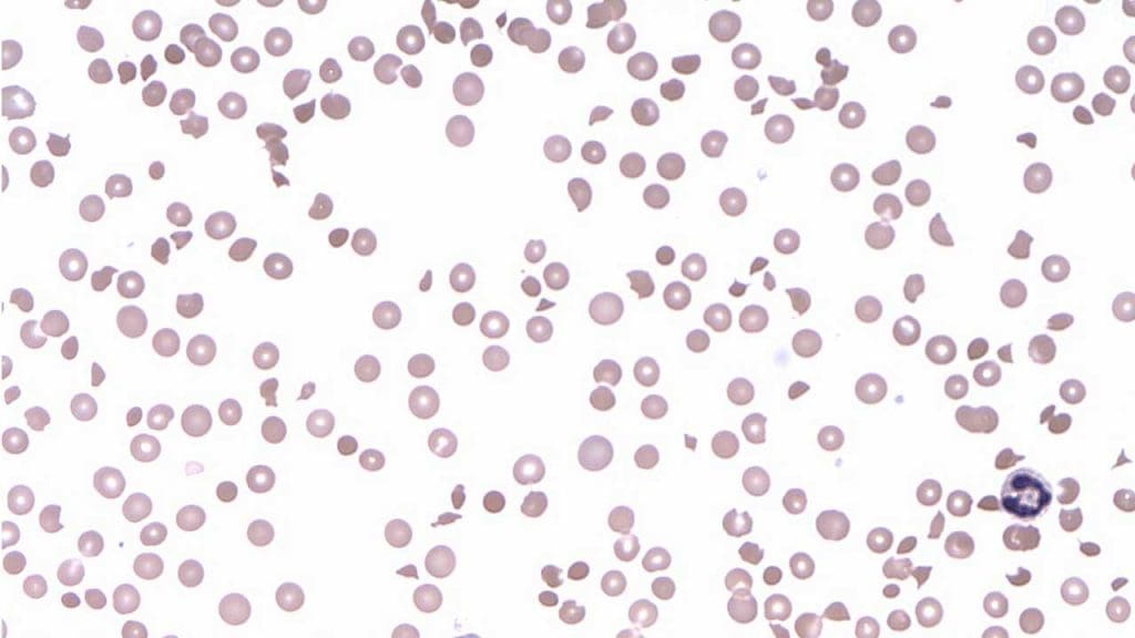 Characteristic features of TTP include the presence of spherocytes, schistocytes and polychromatic and sometimes nucleated red cells.