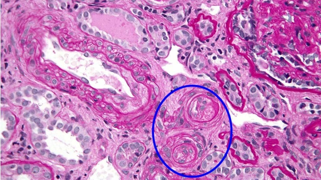 Thrombotic microangiopathy in the kidney. 