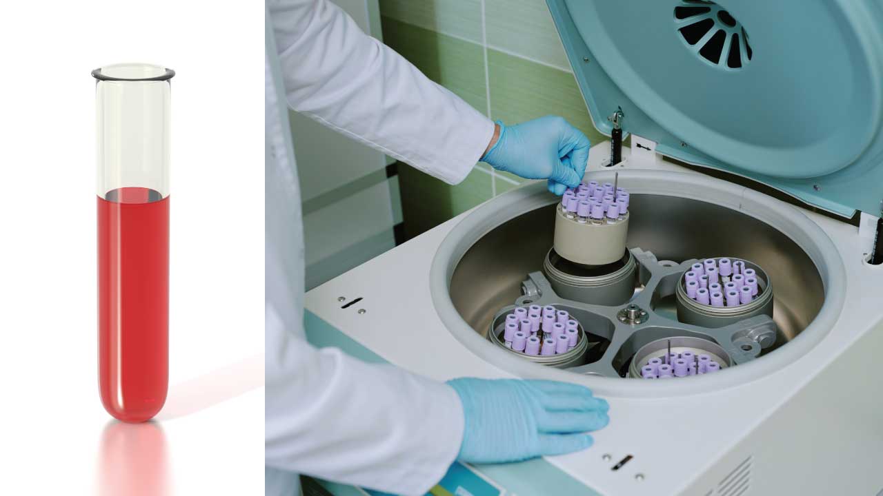 Hemolysate preparation will produce a clear and transparent hemolysate to be used for further hemoglobinopathies and thalassemia investigation. 