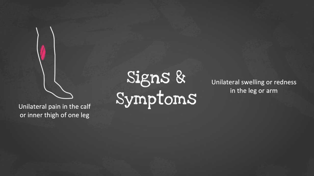 Image showing unilateral leg pain as well as unilateral swelling as common signs and symptoms of VTE