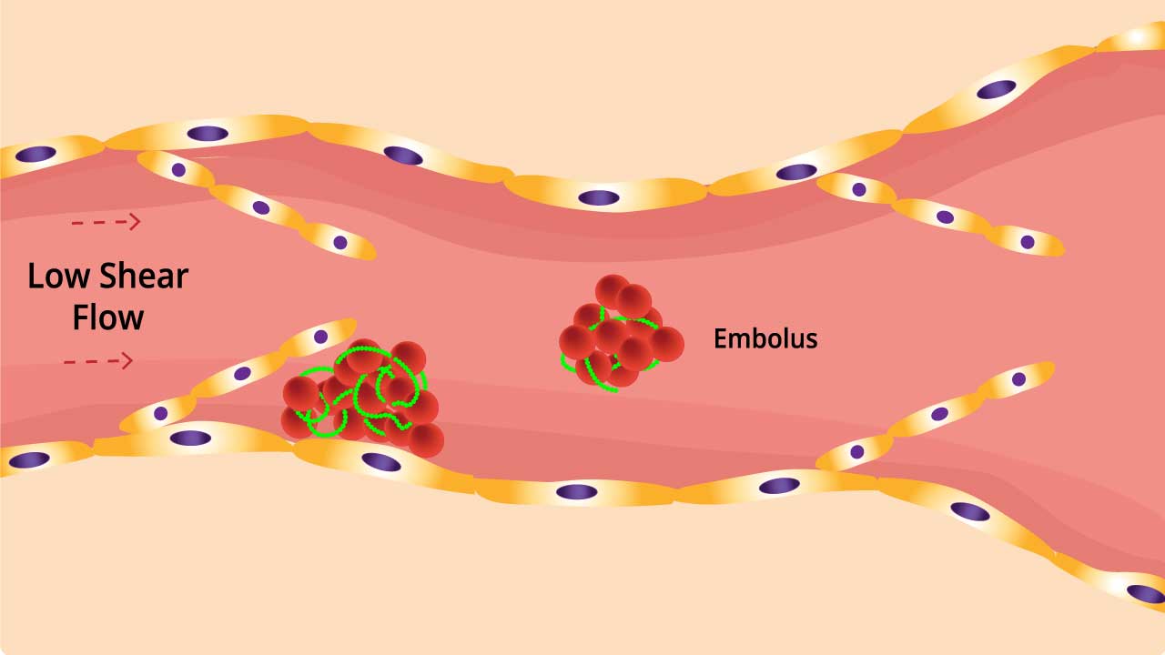 Inside VTE: Blood flow slows, platelets clump, fibrin mesh traps cells, forming a clot. Breakaway clot can travel to lungs, leading to life-threatening pulmonary embolism (PE).