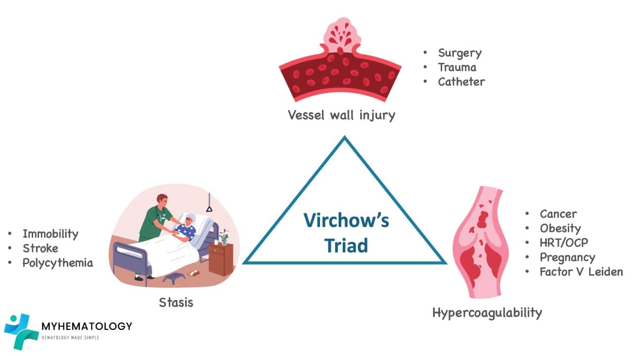 Virchow’s Triad is the foundational framework for understanding venous thrombogenesis or venous thromboembolism also known as VTE on a pathophysiological level, consisting of three intersecting factors: venous stasis, endothelial injury, and hypercoagulability. Venous stasis occurs when blood flow slows or pools often due to prolonged immobility, obesity, pregnancy, or heart failure, allowing activated clotting factors to accumulate in the low-pressure valve pockets of deep veins. Endothelial injury acts as the primary trigger, where damage to the vessel wall from surgery, trauma, or intravenous catheters exposes the pro-thrombotic subendothelial matrix to platelets. Finally, hypercoagulability represents a biochemical shift toward a pro-thrombotic state, driven by inherited conditions like Factor V Leiden or Protein C/S deficiency, or acquired triggers such as malignancy, oral contraceptives, and smoking. When these three elements coincide, they overwhelm the body’s natural anticoagulant defenses, leading to the formation of a fibrin-rich thrombus that characterizes venous thromboembolism.