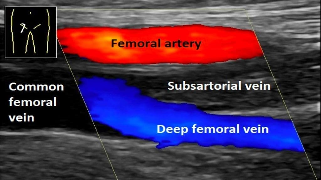 Doppler ultrasonogaphy of deep vein thrombosis (DVT) showing an absence of blood flow in the blocked vein. 